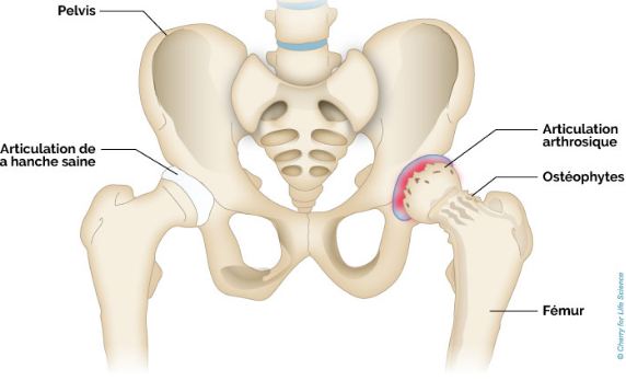 Articulation de la hanche 